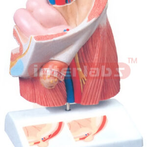 INGUINAL HERNIA