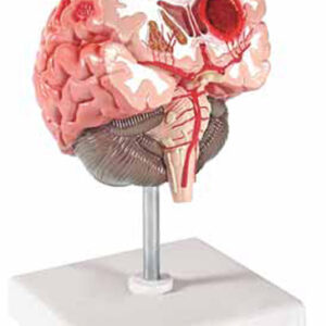 Brain Pathologies