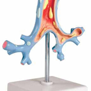 Pathological Model of the Bronchi