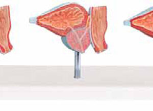 Normal and Diseased Prostate Gland