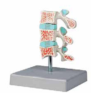 Advanced Osteoporosis Model