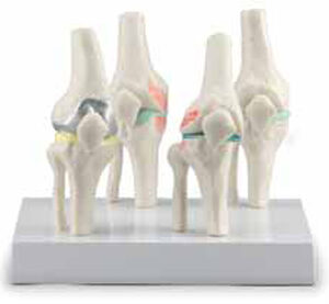 Knee Joints Set