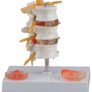 3 Lumbar Vertebrae with Hernia and Prolapsed Intervertebral Disc