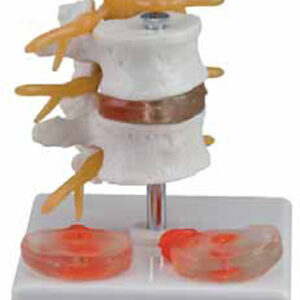 2 Lumbar Vertebrae with Hernia and Prolapsed Intervertebral Disc