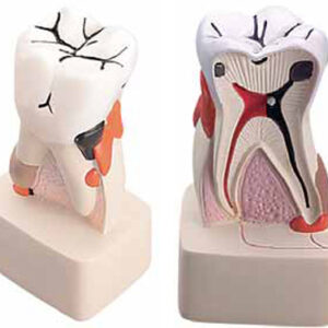 Dental Pathology Model