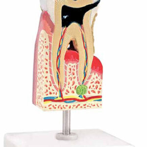 Lower Molar with Caries