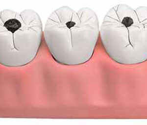 Dental Caries Model