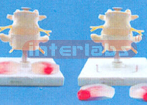 LUMBAR SET WITH 3 DISEASE DISCS WITH STAND