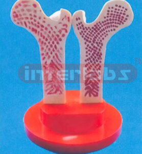 GIANT FEMUR HEAD SHOWING OSTEOPOROSIS THE HEAD AND UPPER END OF AN ADU L T FEMUR DIVIDED LONGITUDINALLY AND HINGED.ONE HALF IS NORMAL, THE OTHER SHOWS THE EFFECTS OF OSTEOPOROSIS ON THE SURFACE AND ST