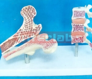 GIANT MORBIDITY COMPARISONS MODEL FOR LUMBAR VERTEBRAL WITH 3-STAGE AND FEMUR BONE