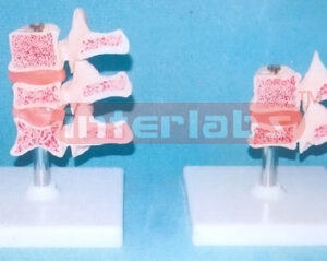CUTAWAY OSTEOPOROSIS