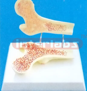 MIDDLE FEMUR BONE TWINS (FEMORAL HEAD SECTION SHOWING OSTEOPOROSIS