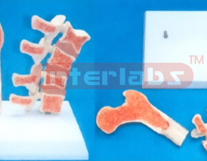 MIDDLE VERTEBRA AND MORBIDITY FEMUR BONE DEMONSTRATION MODEL