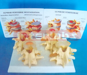 FOUR TYPE VERTEBREA NORMAL & DISEASER COMPOSITION (4 PAIRS / SET)