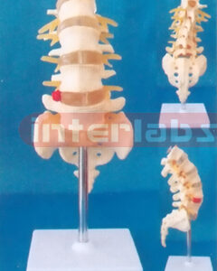 LUMBAR VERTEBRAE WITH SACRUM & COCCYX AND HERNIATED DISC