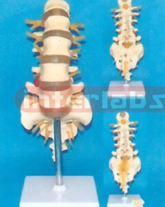 BIG LUMBAR VERTEBRAE WITH HERNIATED DISANO SACRUM & COCCYX, OPENED AND SEEN COCCYX NERVE BRANCHES, WITH STAND SIZE : 30 x 12 x 10 cm