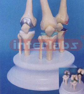 DESK-TYPE, DISEASE MOVABLE JOINTS MODEL WITH ROUND STAND AND DESCRIPTION PLATS