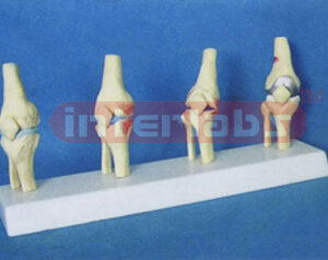 MIDDLE ADULT KNEE JOINTS SYNTHESIS MODEL FOR HEALT COMPARE WITH DISEASES (COLLE CTION 4 PCS/SET)  i.e. A TYPE, D TYPE, B TYPE & E TYPE