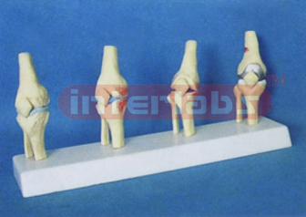 MIDDLE ADULT KNEE JOINTS SYNTHESIS MODEL FOR HEALT COMPARE WITH DISEASES (COLLE CTION 4 PCS/SET) i.e. A TYPE, D TYPE, B TYPE & E TYPE