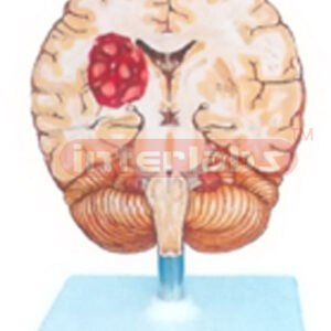 HUMAN BRAIN STROKE MODEL