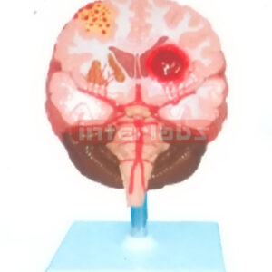 BRAIN STROKE DEMONSTRATION MODEL