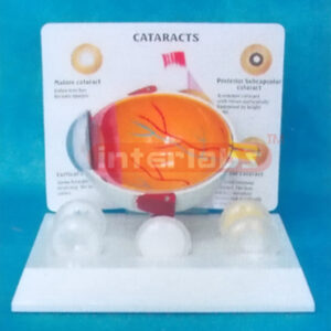 WEST? DESK? TYPE,ENLARGED DEMONSTRATING MODEL OF CATARACTS