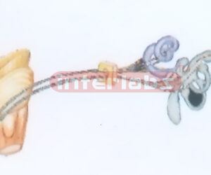 HUMAN MODEL OF THE VESTIBUL COHLEAR NERVE