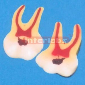 GIANT CARIES MOLAR, 2 PCS/SET