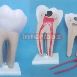 GIANT CARIES MOLAR, (3 PCS / SET)
