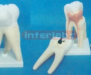 WEST-STYLE CARIES MOLAR MODEL WITH SQUARE PLASTIC BASE (3 PCS / SET)