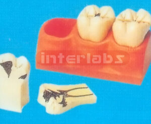 DENTAL CANIES DECOMPOSITION TOOTH MODEL