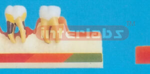 CLASSIFIED PARADONTOSIS MODEL