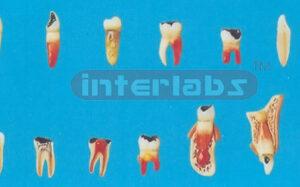 TEETH PATHOLOGIC MODEL CASE OF TEETH ODONTOPATHIES