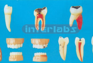 TEETH DISEASE SERIES MODEL