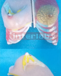 ANATOMY OF THE HEALTH AND MORBIDITY BREAST