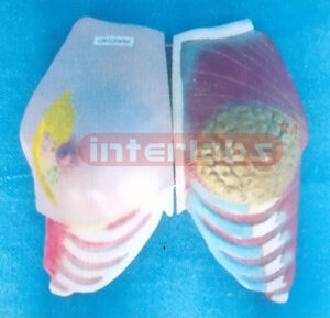 ANATOMY OF THE HEALTH AND MORBIDITY BREAST