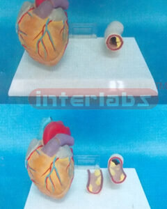 MIDDLE HEART MODEL WITH DISEASE BLOOD TUBE