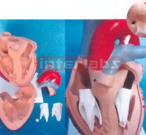 MIDDLE HEART WITH ATRIAL SEPTAL AND VENTRICULAR SEPTAL DEFECTS