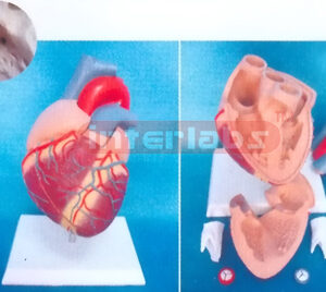MIDDLE HEART WITH VENTRICULAR SEPTAL DEFECT