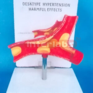 DSKTYPE (HYPERTENSION HARMFUL EFFECTS) DISEASE ARTERY WITH DESCRIPTION PLATE (A TYPE) 6.5 x 11.5 x 16.5cm