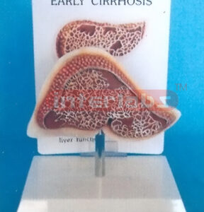 DESK TYPE EARLY CIRRHOSIS MODEL WITH DESCRIPTION PLATE
