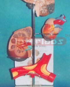 VERTICAL HYPERTENSION MODEL (ASIA TYPE)