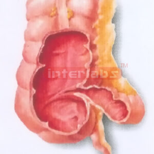 HUMAN HEALTH ILEOCECAL PART (INTERNAL ASPECT) MODEL