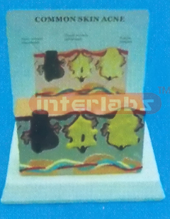 DESK/SQUARE TYPE, DISEASE (ACNE) SKIN WITH DESCRIPTION PLATE