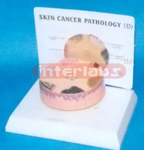 HUMAN SKIN CANCER MODEL WITH DESCRIPTION PLATE