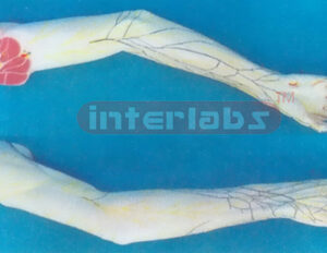 ARM VEIN DISTRIBUTION MODEL
