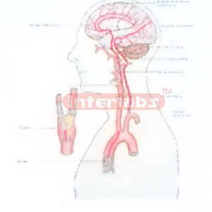 HANGING HUMAN THROMBUS PRODUCTION AND SITE PEMSTRATION IN BRAIN