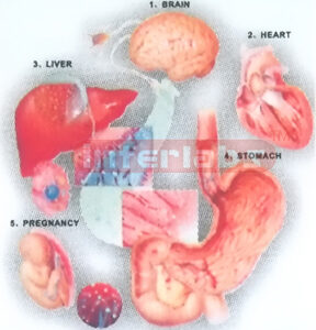 HANGING HUMAN ALCOHOL DISEASES MODEL DEMONSTRATING