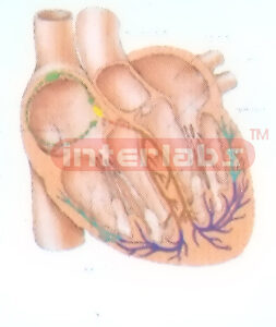 HANGING HUMAN CONDUCTING BYPASS OF THE HEART