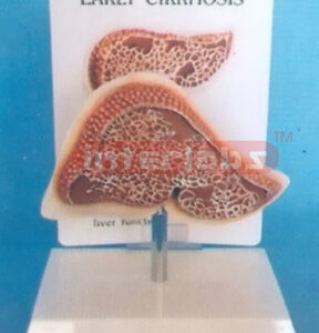 DESK-TYPE, EARLY CIRRHOSIS MODEL WITH DESCRIPTION PLATE